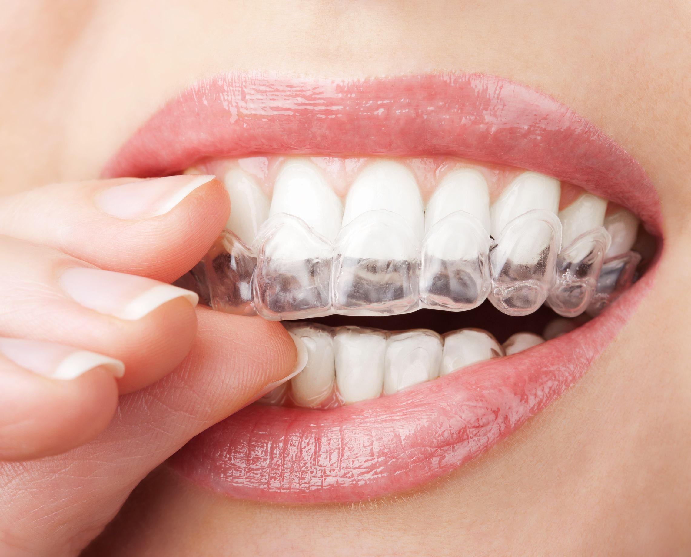 Invisalign in Charlotte Can Instill Confidence and Create a Great Smile