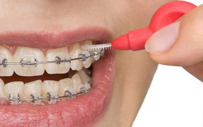 Invisalign Fitchburg WI Benefits for Families Seeking Comfortable Orthodontic Care